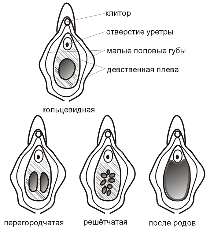 Показания к гименопластике